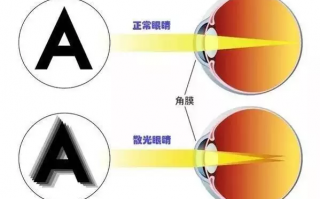 散光眼镜是什么，散光眼镜是什么镜片