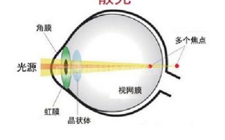 散光怎么区分，顺轴散光和逆轴散光怎么区分