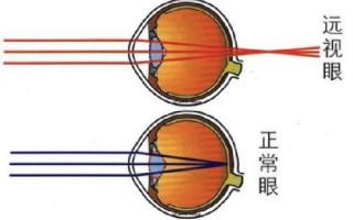 远视为什么带眼镜，远视为什么带眼镜还看不清远处的